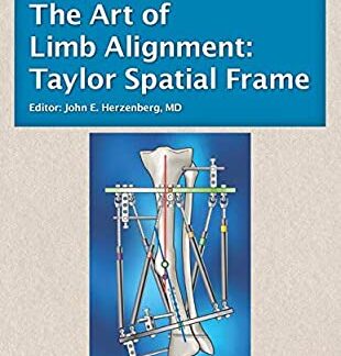 the art of limb alignament taylor spatial frame