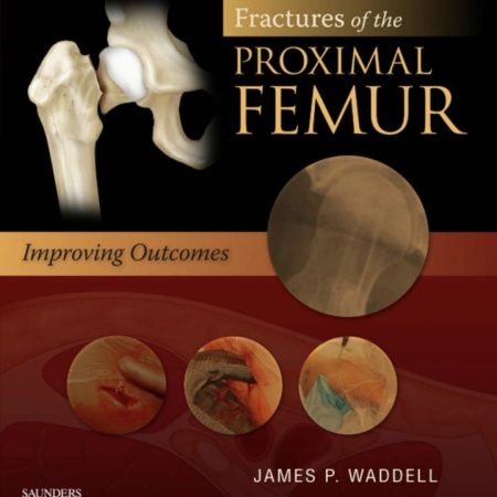 fractures of the proximal femur