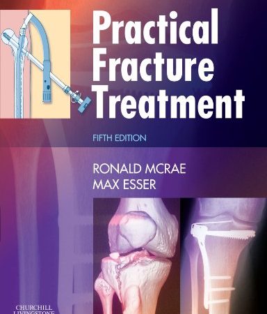 Practical fracture treatment