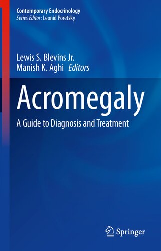 Acromegaly: A Guide to Diagnosis and Treatment